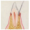 gingivitis tooth.JPG (6710 bytes)