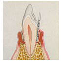 moderate periodontitis tooth.JPG (6592 bytes)