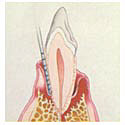 advanced_periodontitis_tooth.JPG (6525 bytes)